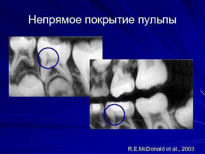 Апексогенез и апексификация презентация