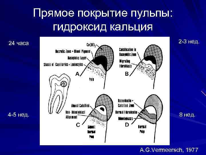 Методы сохранения пульпы. Непрямое покрытие пульпы этапы. Прямое и Непрямое покрытие пульпы зуба. Метод прямого покрытия пульпы. Биологический метод (прямое и Непрямое покрытие пульпы зуба).