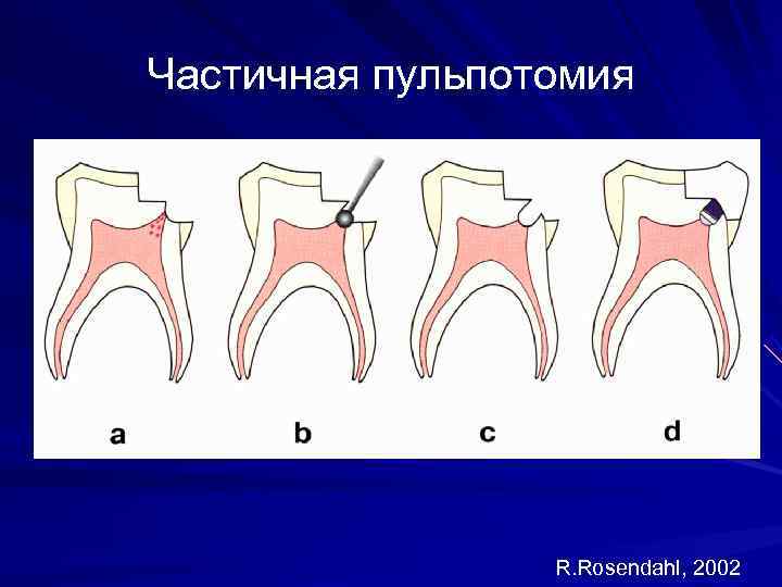 Этапы витальной ампутации пульпы схема