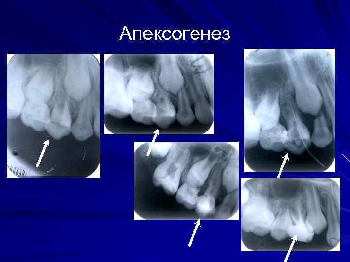 Апексогенез и апексификация. Апексогенез методика. Апексогенез постоянных зубов. Апексогенез и апексификация у детей.