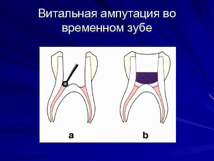 Этапы витальной ампутации пульпы схема