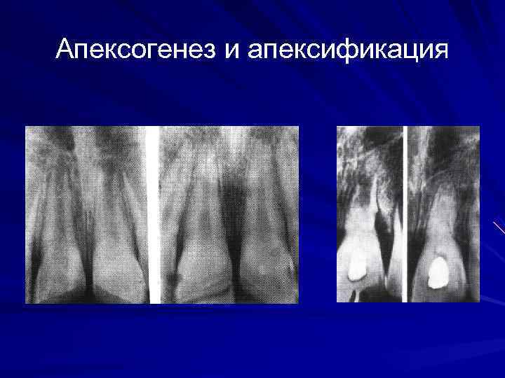 Апексогенез и апексификация