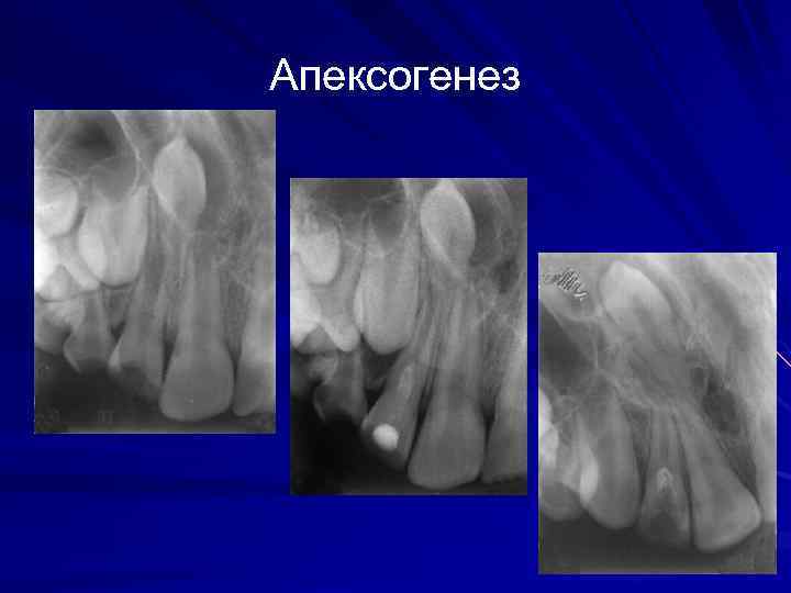 Апексогенез и апексификация. Апексогенез постоянных зубов. Незавершенный апексогенез. Апексогенез и апексификация у детей.