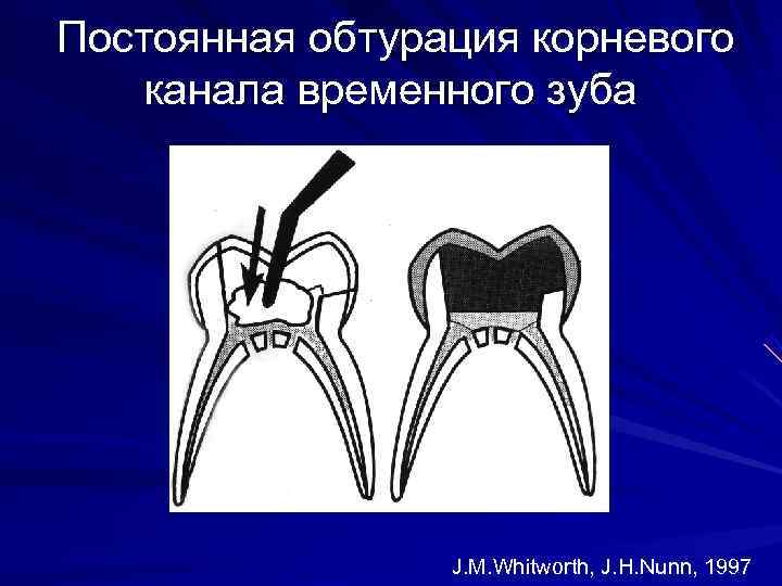 Временной канал. Система для обтурации корневых каналов. Постоянная обтурация корневых каналов материалы. Корневые каналы временных зубов. Пломбирование корневых каналов временных зубов.