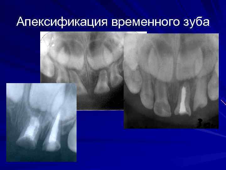 Апексогенез и апексификация презентация