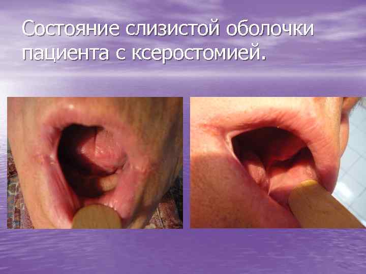 Состояние слизистой оболочки пациента с ксеростомией. 