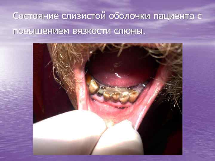 Состояние слизистой оболочки пациента с повышением вязкости слюны. 