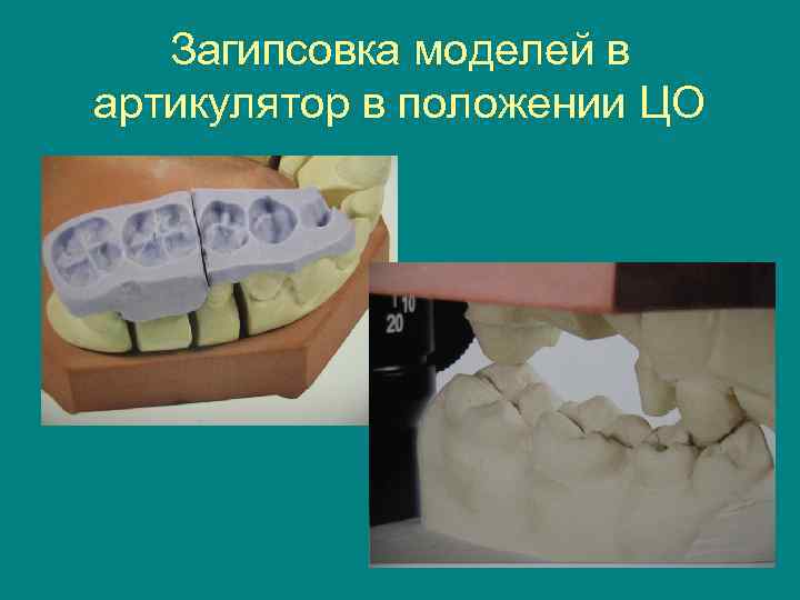   Загипсовка моделей в артикулятор в положении ЦО 