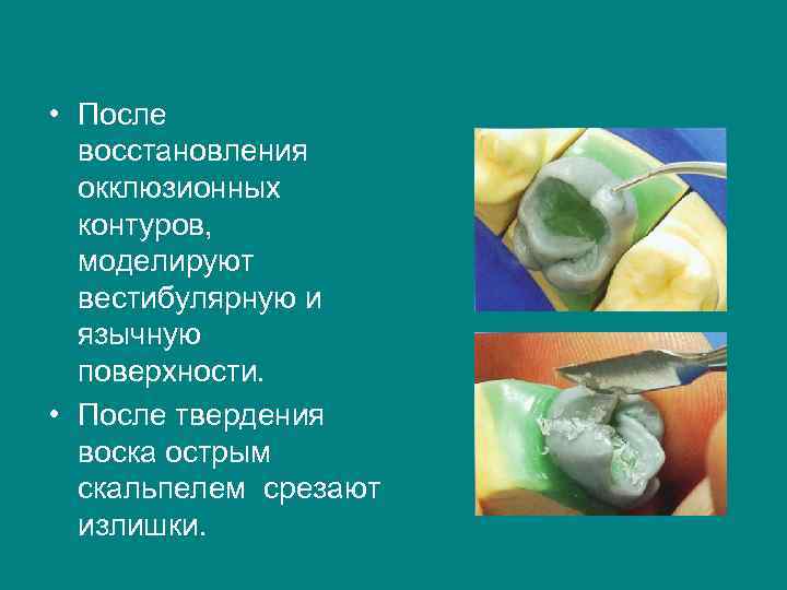  • После  восстановления  окклюзионных  контуров,  моделируют  вестибулярную и