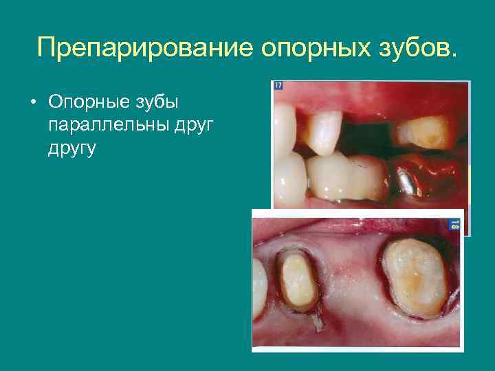 Препарирование опорных зубов.  • Опорные зубы  параллельны другу 