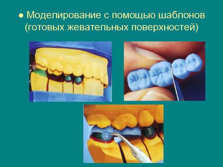 ● Моделирование с помощью шаблонов (готовых жевательных поверхностей) 