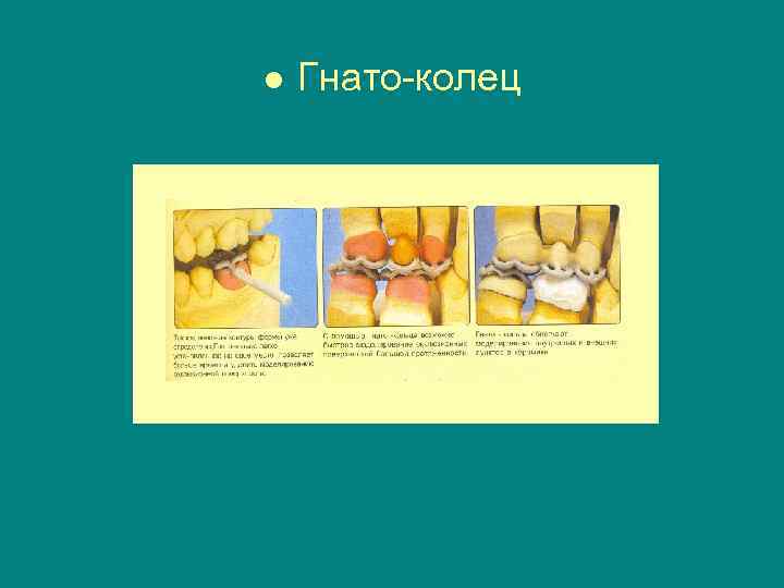 ● Гнато-колец 