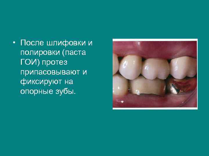  • После шлифовки и  полировки (паста  ГОИ) протез  припасовывают и