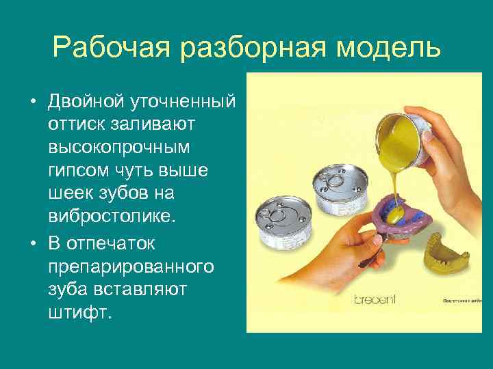 Изготовление цельнолитого мостовидного протеза презентация