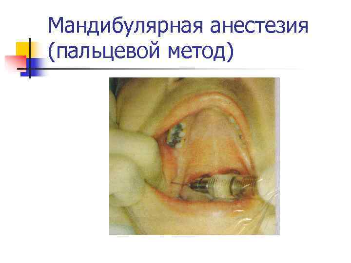 Мандибулярная анестезия (пальцевой метод) 