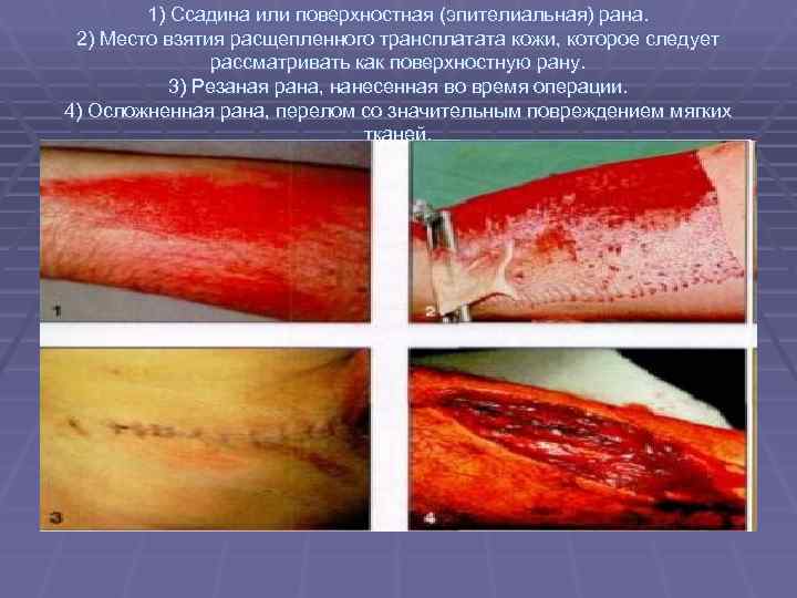   1) Ссадина или поверхностная (эпителиальная) рана.  2) Место взятия расщепленного трансплатата