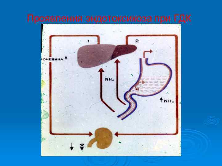 Проявления эндотоксикоза при ГДК 