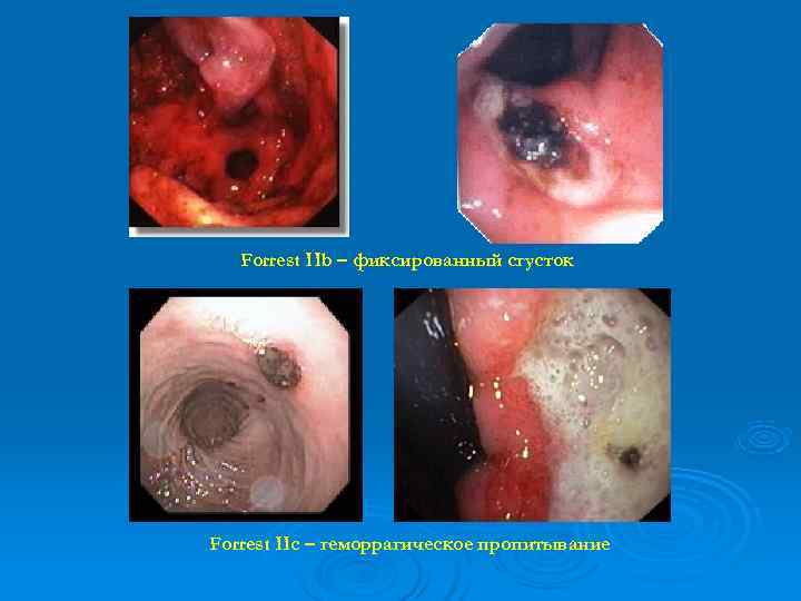   Forrest IIb – фиксированный сгусток Forrest IIc – геморрагическое пропитывание 