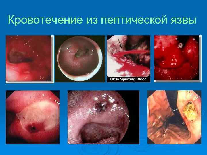 Кровотечение из пептической язвы 