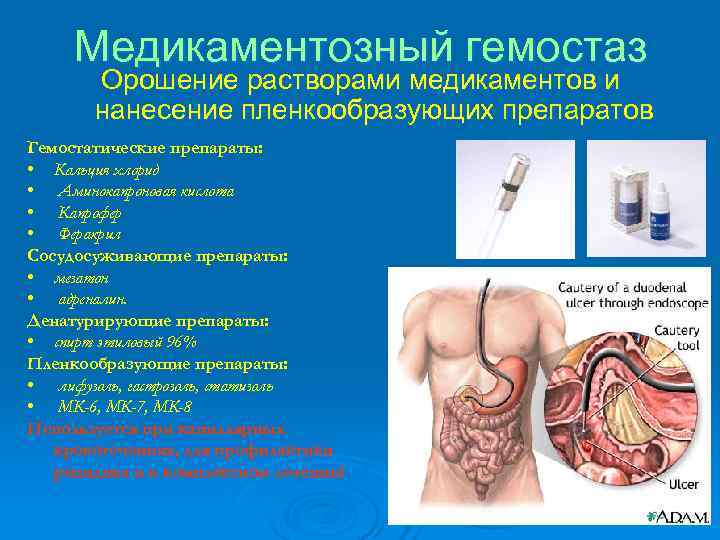 При развитии кровотечения из язвенного дефекта на фоне приема нпвс рекомендуется назначать