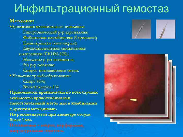  Инфильтрационный гемостаз Методики:  • Достижение механического сдавления:  v. Гипертонический р-р адреналина;