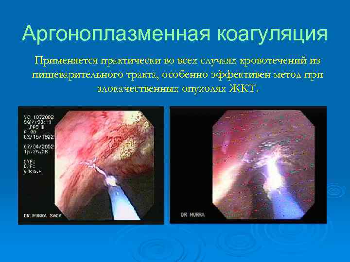 Кровотечение из геморроидальных узлов карта вызова