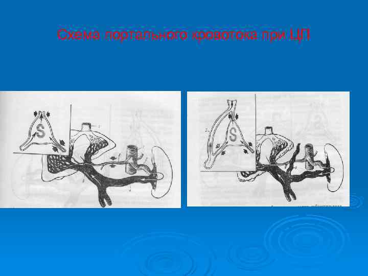 Схема портального кровотока при ЦП 