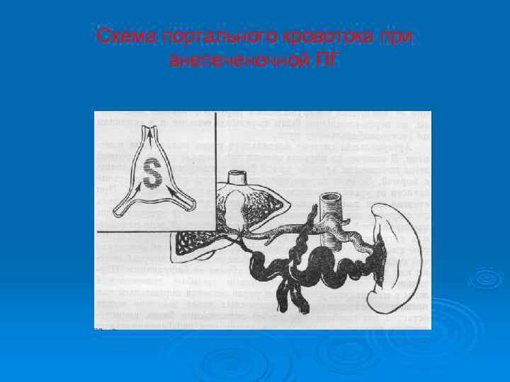 Схема портального кровотока при  внепеченочной ПГ 