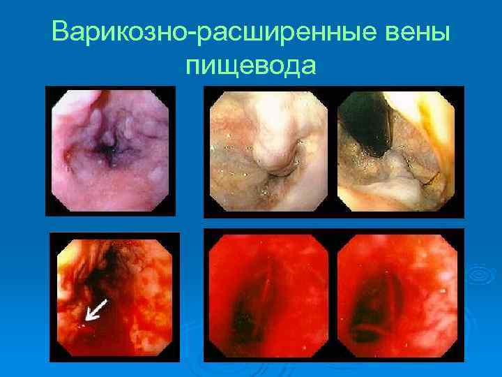 Варикозно-расширенные вены   пищевода 