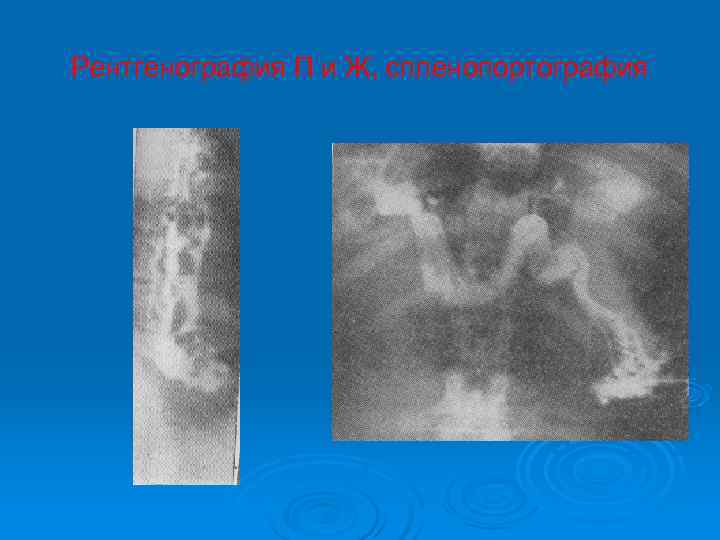 Рентгенография П и Ж, спленопортография 
