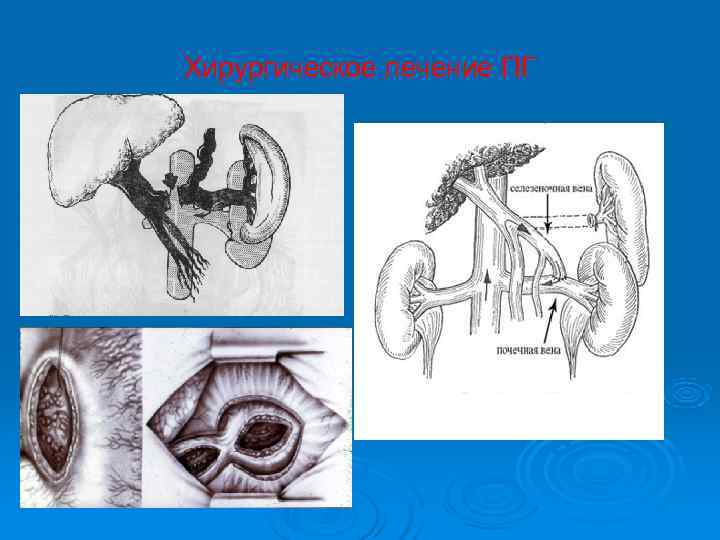 Хирургическое лечение ПГ 
