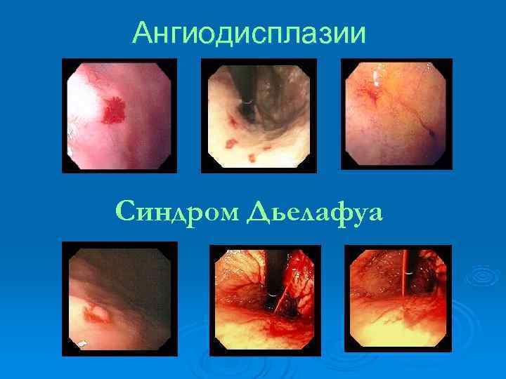  Ангиодисплазии Синдром Дьелафуа 