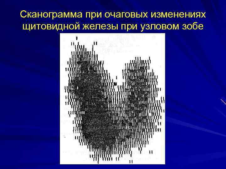 Сканограмма при очаговых изменениях щитовидной железы при узловом зобе 