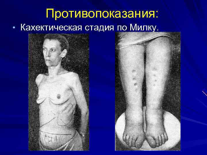   Противопоказания:  • Кахектическая стадия по Милку. 