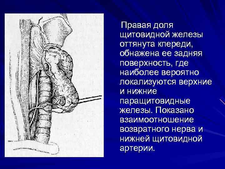 Правая доля щитовидной железы оттянута кпереди, обнажена ее задняя поверхность, где наиболее вероятно локализуются