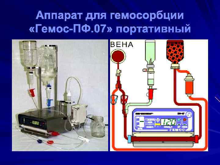  Аппарат для гемосорбции «Гемос-ПФ. 07» портативный 