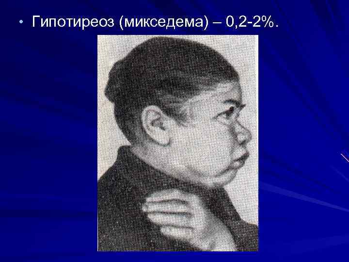  • Гипотиреоз (микседема) – 0, 2 -2%. 