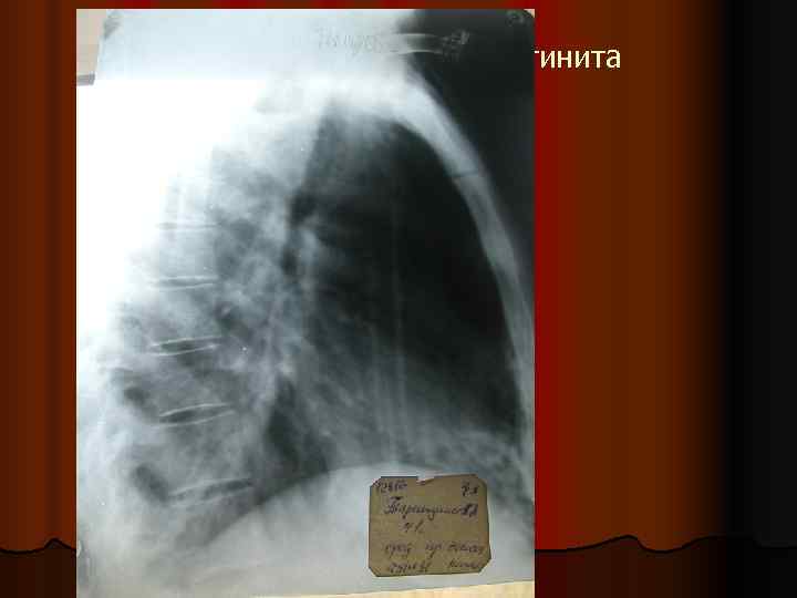 Клиника острого медиастинита 