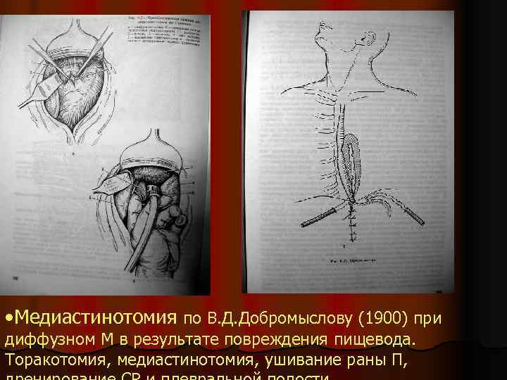 • Медиастинотомия по В. Д. Добромыслову (1900) при диффузном М в результате повреждения