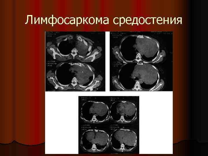 Кисты средостения презентация