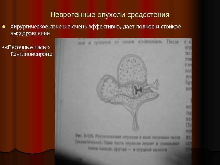    Неврогенные опухоли средостения l  Хирургическое лечение очень эффективно, дает полное