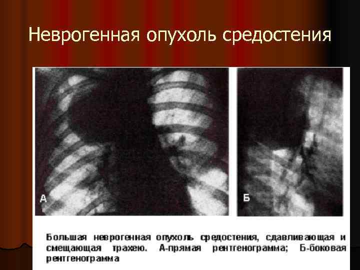 Неврогенная опухоль средостения 