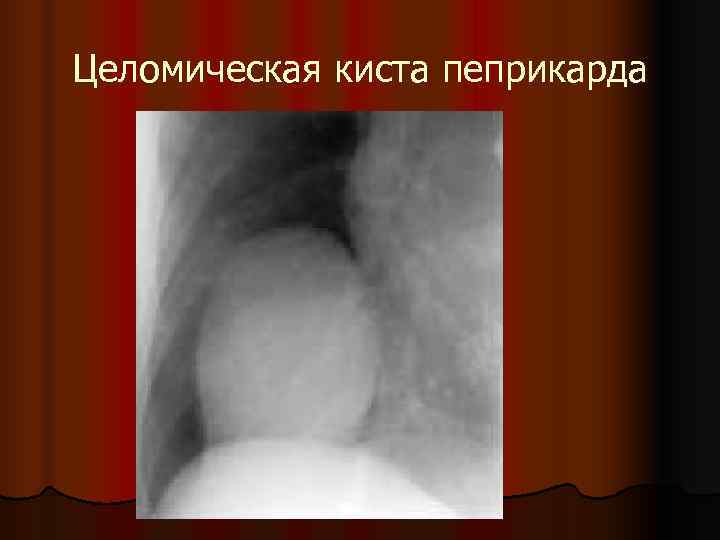 Целомическая киста пеприкарда 