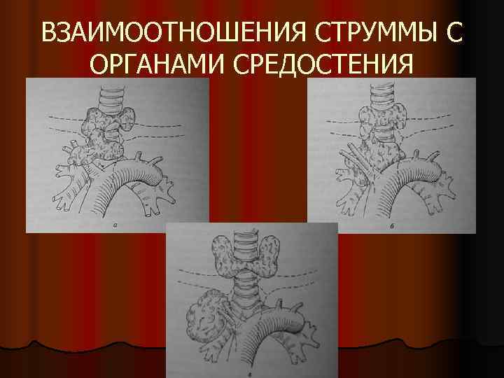 ВЗАИМООТНОШЕНИЯ СТРУММЫ С  ОРГАНАМИ СРЕДОСТЕНИЯ 