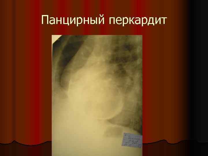 Панцирный перкардит 