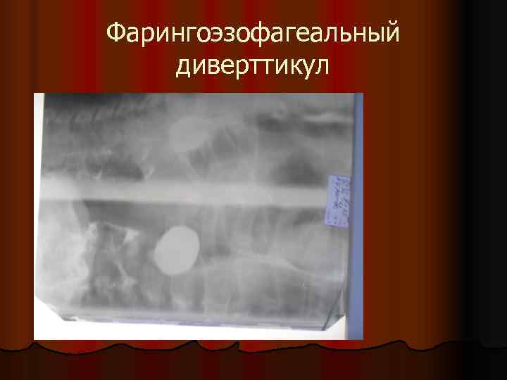 Фарингоэзофагеальный диверттикул 