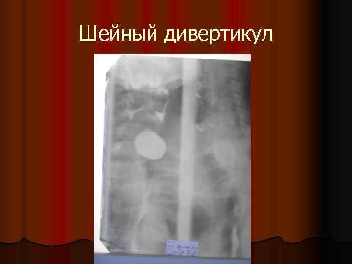 Шейный дивертикул 