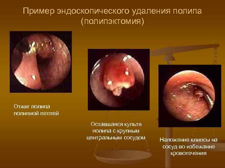   Пример эндоскопического удаления полипа    (полипэктомия) Отжиг полипа полипной петлей