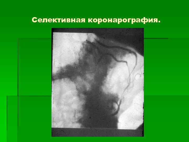 Селективная коронарография. 