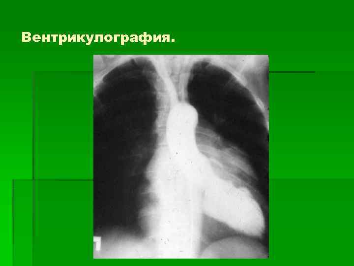 Вентрикулография. 